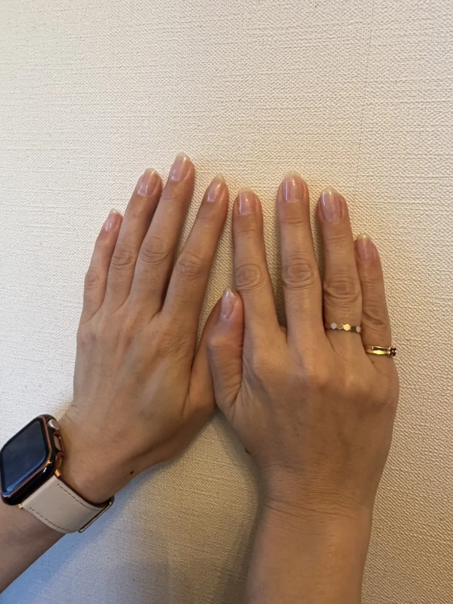 自爪育成の施術例。長さと形が整った健やかな自爪